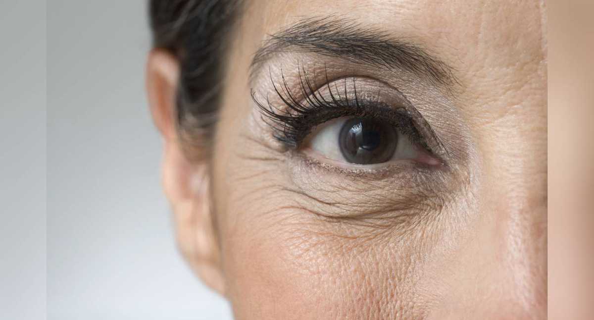 saldar Reclamación vestíbulo Cómo se eliminan las arrugas debajo de los ojos?