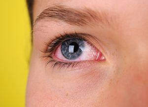 Los ojos rojos pueden presentarse por diversas razones, entre ellas, una infección.