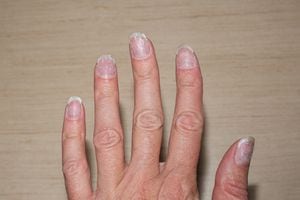Las uñas quebradizas pueden aliviarse y mejorarse con algunos productos caseros.