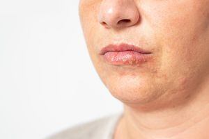 Young woman suffering from herpes on her lips. Concept skin problem, allergy and dermatology. High quality photo