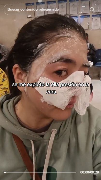 Video: joven sufre quemaduras en la cara tras explosión de olla a presión mientras preparaba lentejas