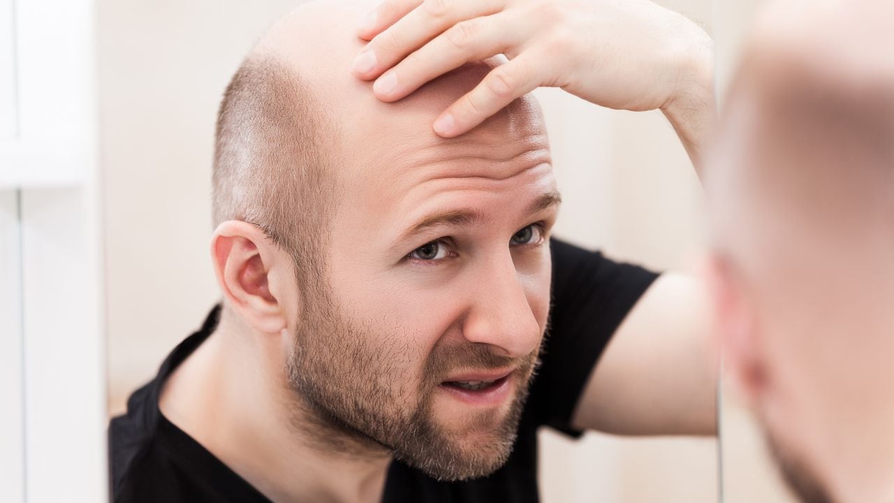 La caída del cabello se asocia con un factor hereditario.