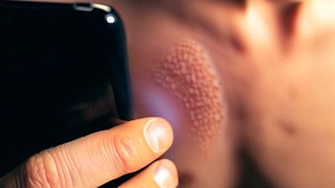 Google lens permitirá detectar enfermedades en la piel con la cámara del smartphone.