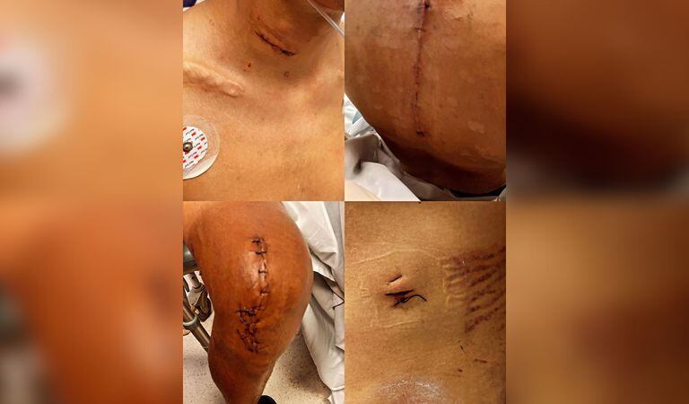 Cicatrices de Egan Bernal, a un año de su duro accidente en Colombia.