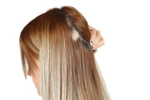 La alopecia femenina se caracteriza por la caída del cabello y afinamiento o pérdida de densidad.