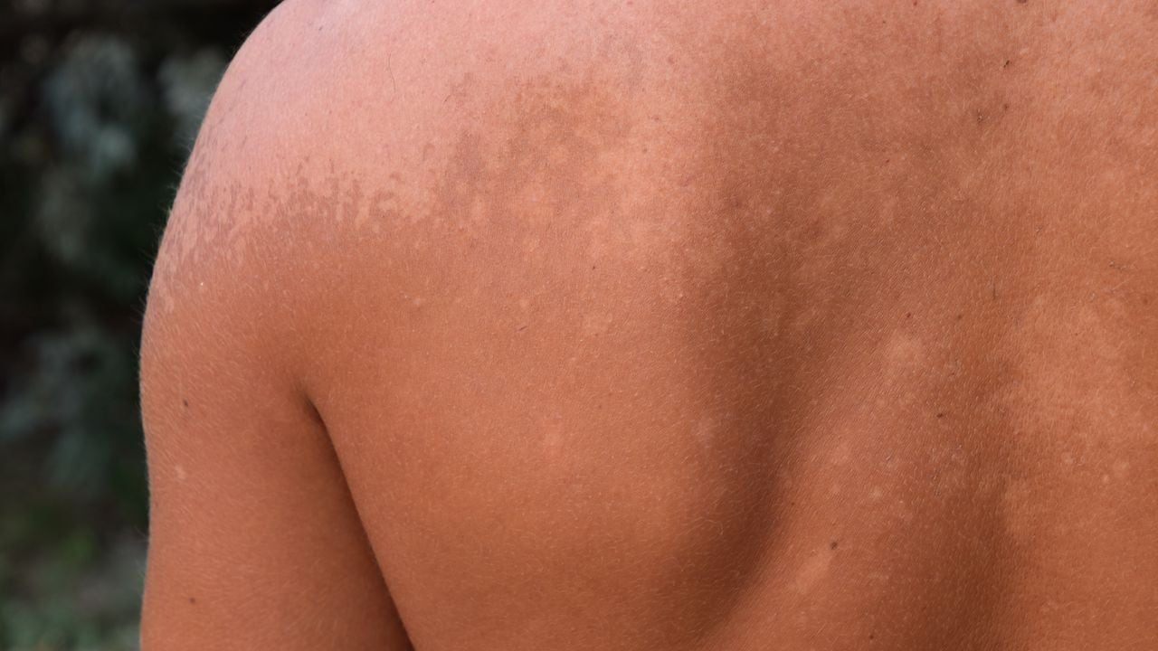 Detalle de hongo en la piel de la espalda