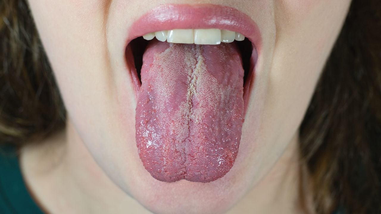La lengua blanca está asociada con diferentes enfermedades.