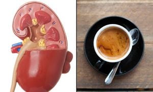 El café y su efecto en el riñón.