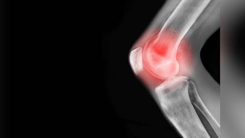La artrosis es una enfermedad degenerativa de los huesos que inicia con la destrucción o perdida gradual del cartílago articular. Foto: Getty Images.