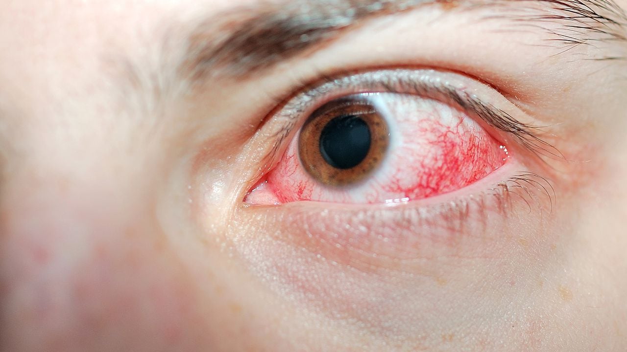 Hemorragia ocular