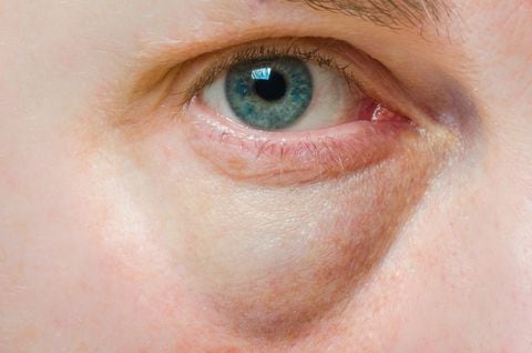 Cuide sus ojos de manera natural: remedios caseros para disminuir las bolsas oculares y su preparación