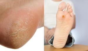 Las callosidades y verrugas en los pies pueden ser tratadas con remedios naturales.