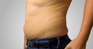 Men's skin Stretch caused by obesity causing stretch marks.