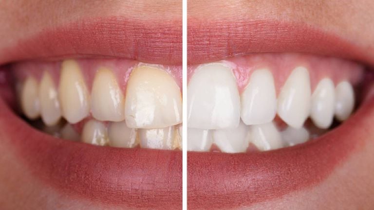 Los dientes pierden su color natural por diversos factores.