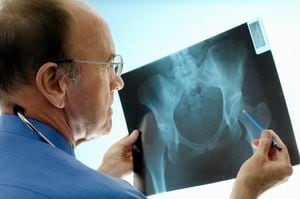 La osteoporosis se puede presentar por la falta de calcio.