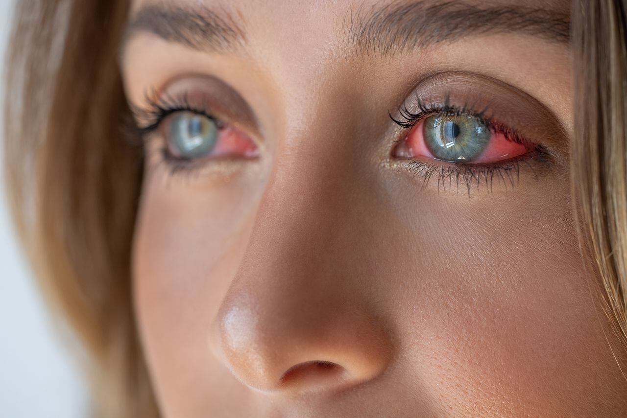 La conjuntivitis es una enfermedad ocular.