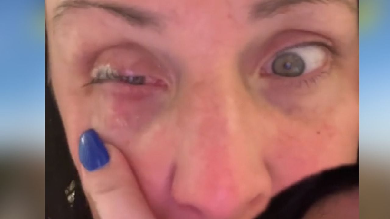 Mujer aplicó accidentalmente en su ojo pegamento para uñas pensando que era gotas oculares