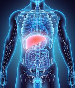 Una de las principales complicaciones del hígado graso es la cirrosis.