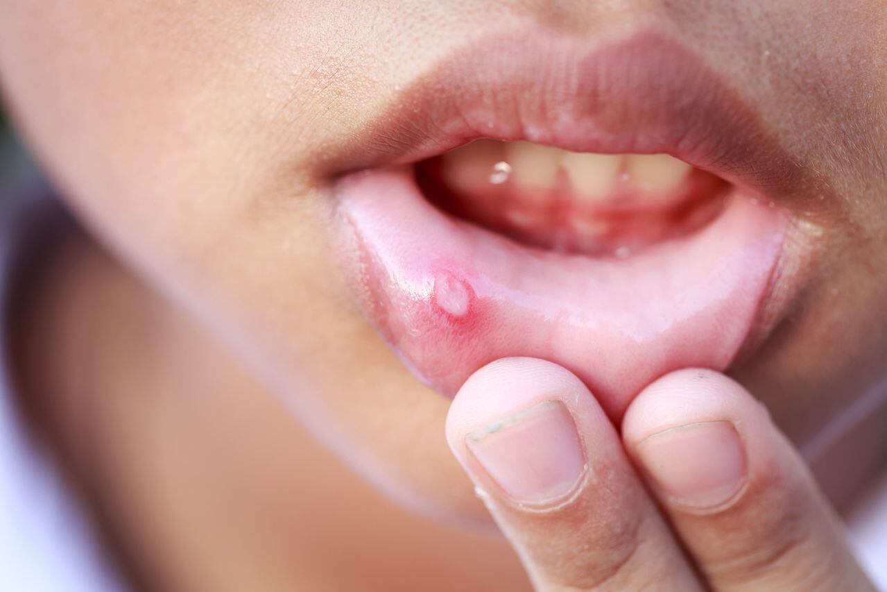 Las úlceras en la boca ocurren en algunos casos por infecciones.