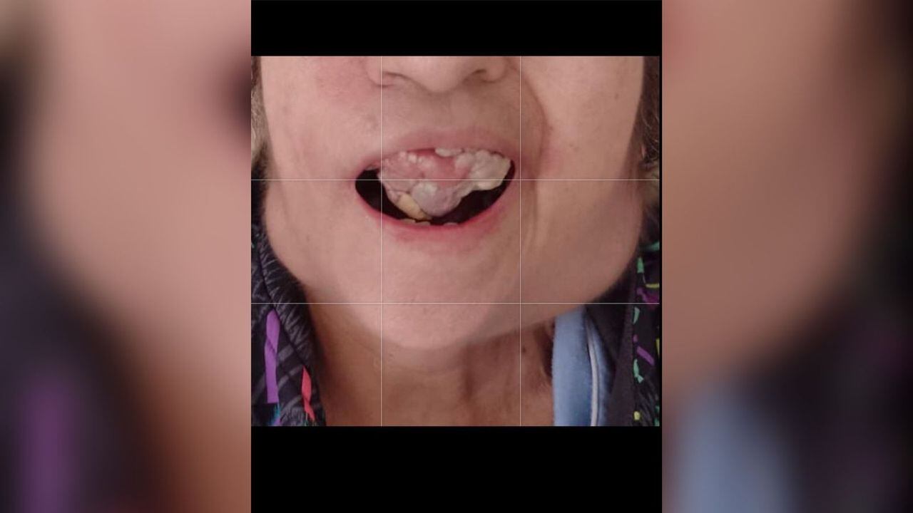 La mujer tiene tumores en la boca y el cuello.