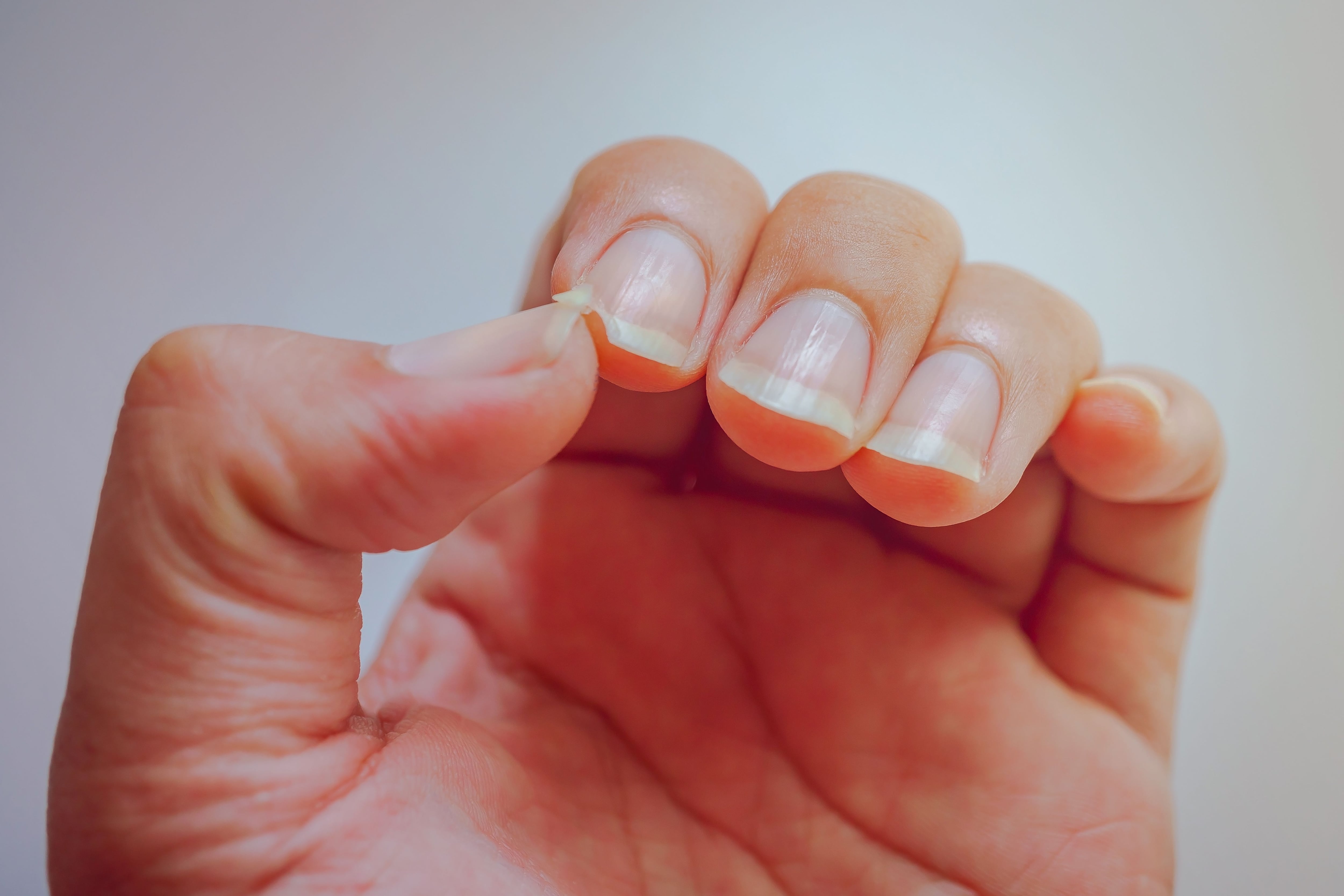 Estrías y surcos en las uñas: las enfermedades que las producen