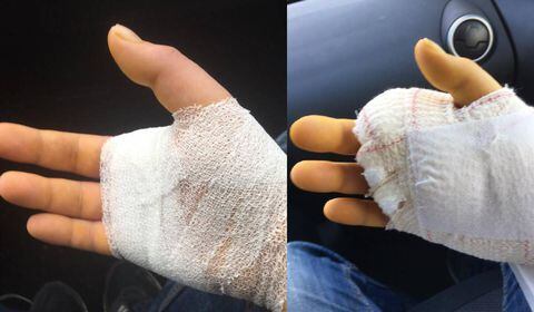 Los doctores decidieron amputar el dedo ya que no estaba funcionando correctamente