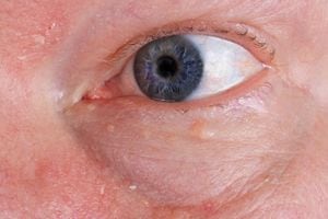 El herpes ocular es una enfermedad vírica que se desarrolla en los ojos.
