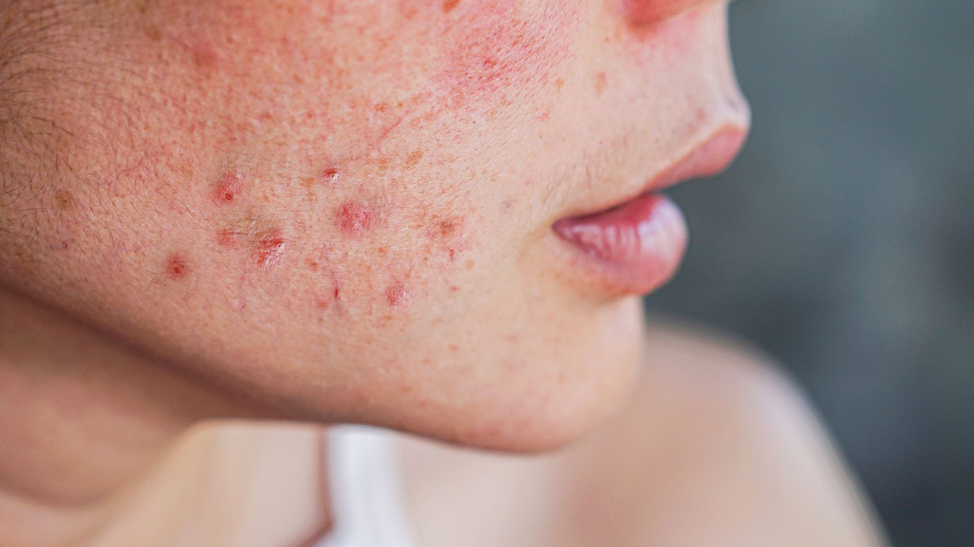 Volver a llamar Viscoso Y equipo Cuáles tratamientos recomiendan para quitar las cicatrices del acné?