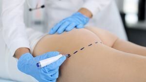 El médico dibuja marcas en las nalgas del paciente con un marcador para dar forma al cuerpo. Concepto plástico de glúteos