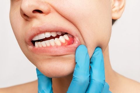 Muchas personas sufren inflamación en las encías, que se origina esencialmente por la acumulación de placa bacteriana, debido a que no se ha realizado una correcta higiene oral diaria.