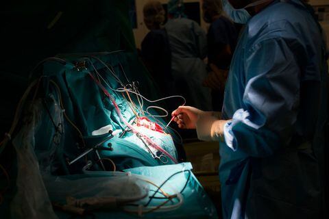 Extirpación de un tumor cerebral, glioma, en el Hospital de Niza, Francia (Foto de: BSIP/Universal Images Group vía Getty Images)