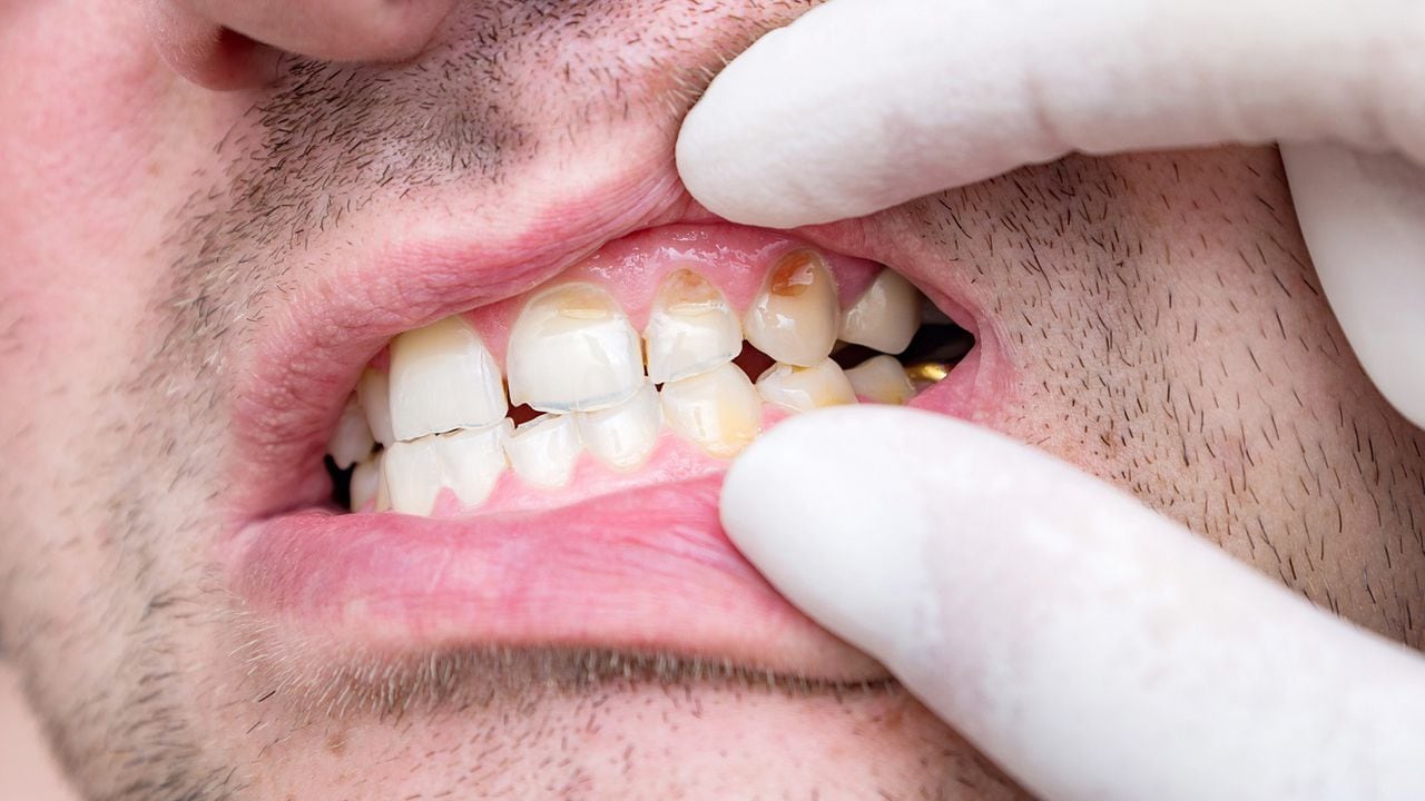 Arriesgado Honesto Cuarto Sarro en los dientes: ¿qué sucede si no se elimina?