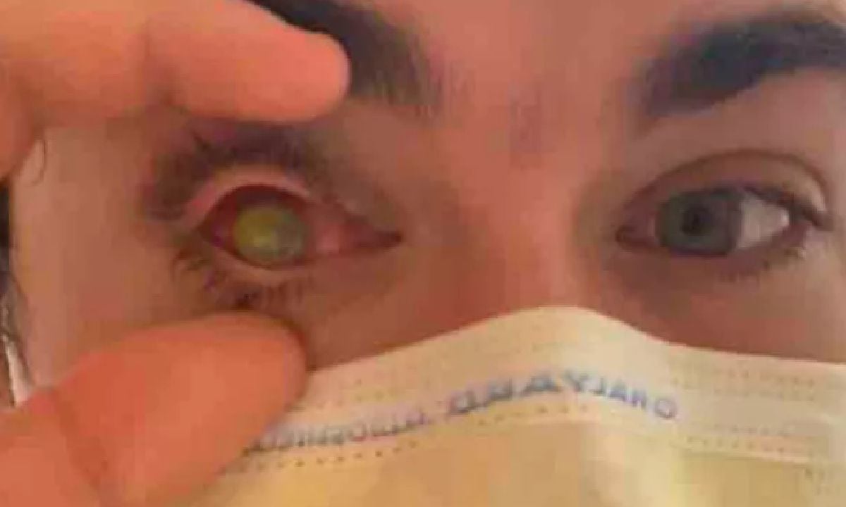 El joven publicó, a través de la redes sociales, una serie de fotografías en las que mostró cómo quedó su ojo tras adquirir la bacteria.