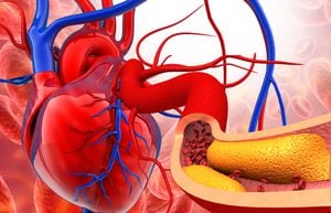 En las arterias se puede acumular placa, también conocido como colesterol. Foto: Getty Images.
