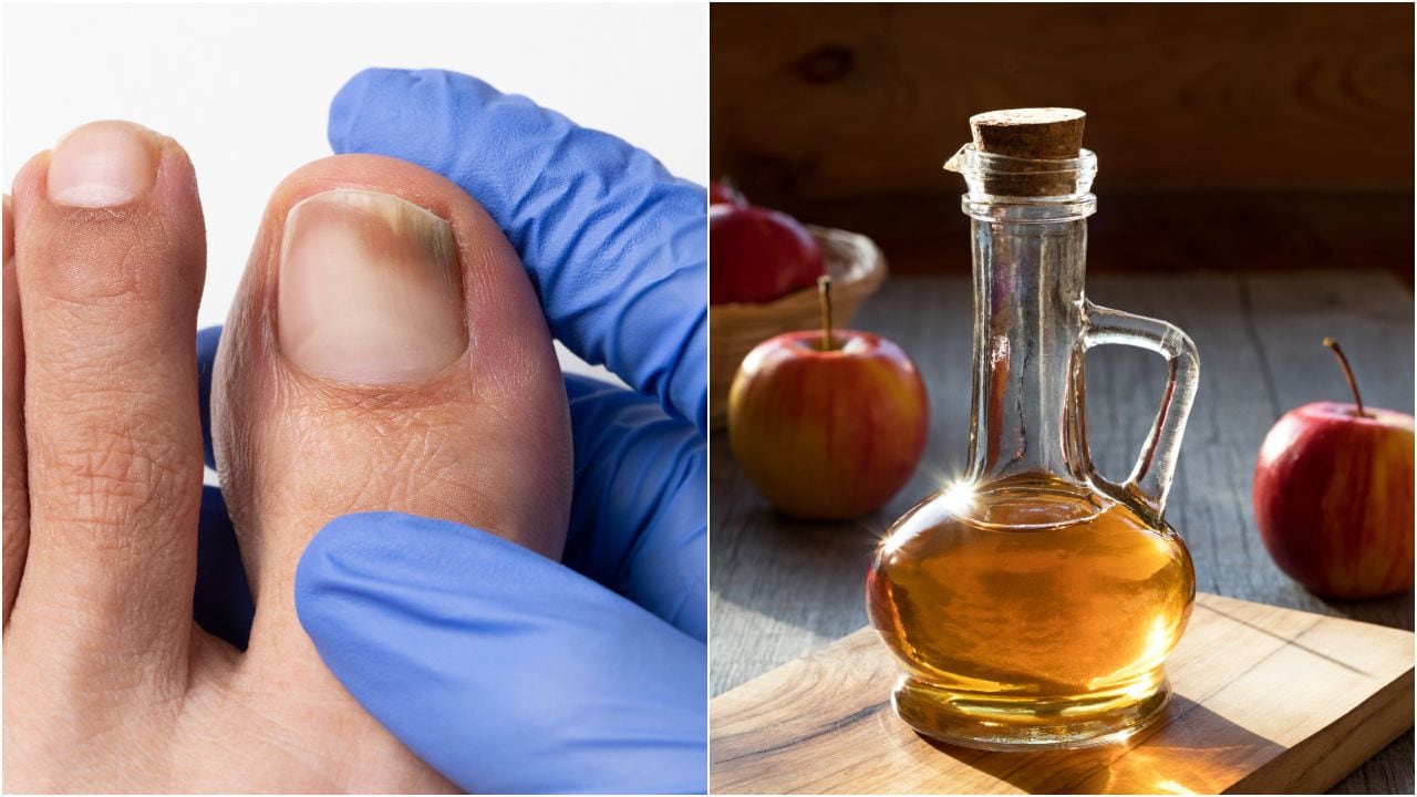 Remedio natural con vinagre de manzana para 'barrer' los hongos de las uñas de los pies