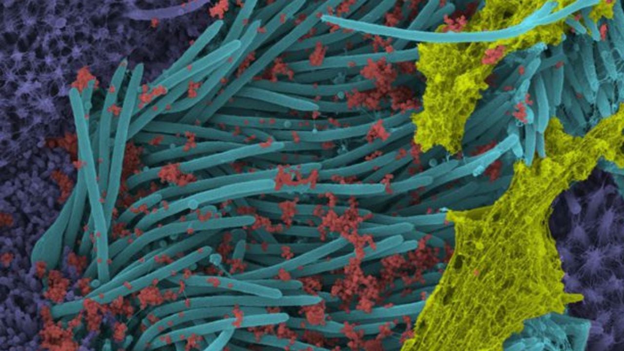 Una imagen de aumento de mayor potencia muestra la estructura y densidad de los viriones del Sars-CoV-2 (de color rojo) producidos por los epitelios de las vías respiratorias humanas. Los viriones son la forma infecciosa completa del virus liberado a las superficies respiratorias por las células huésped infectadas.