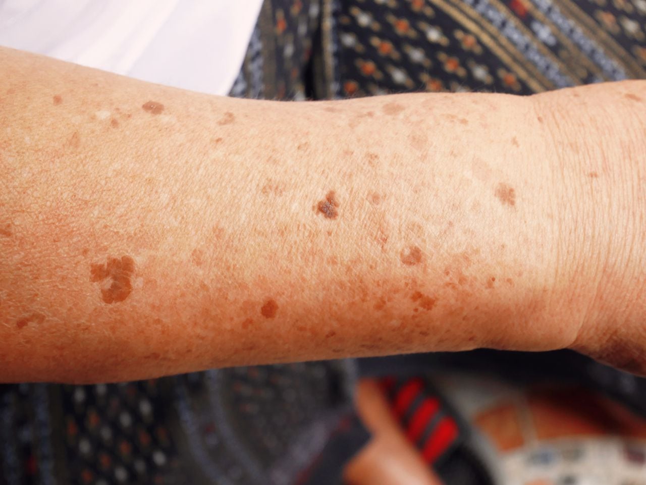 Las manchas de sol en las manos peuden ser producto de los rayos UV.