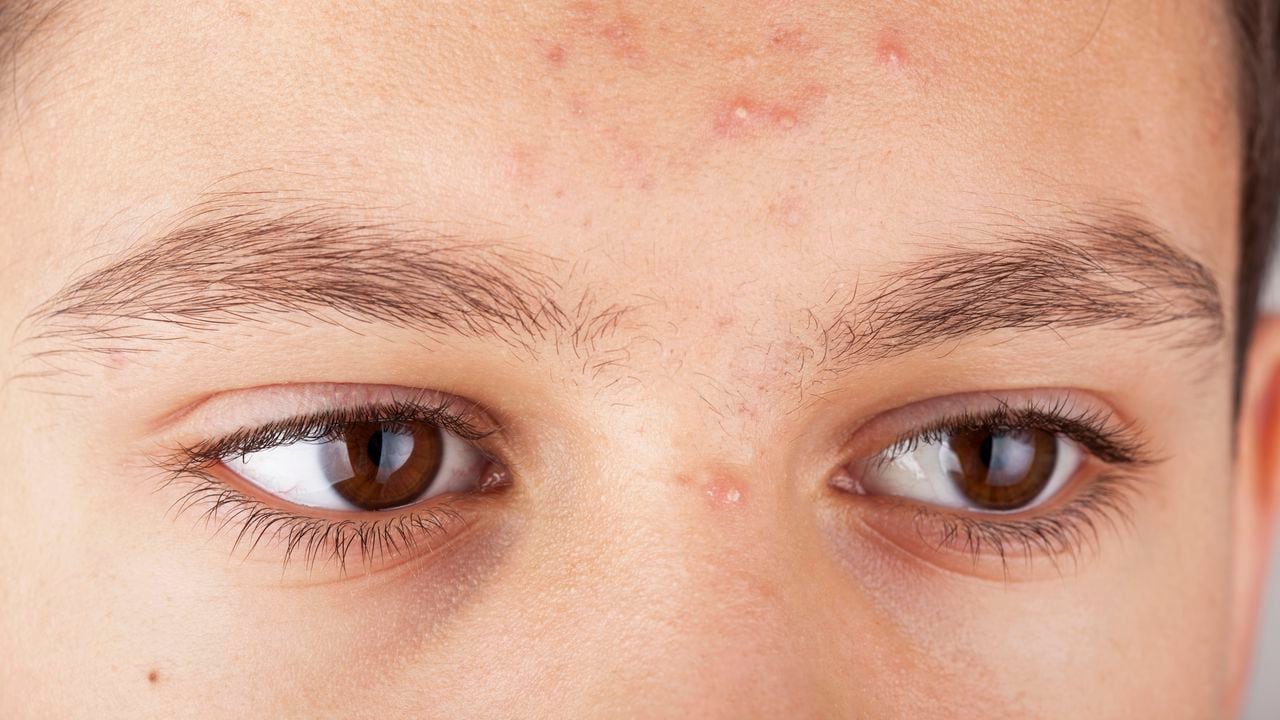 ético Afirmar cebolla Remedios caseros para mejorar la cicatrices del acné