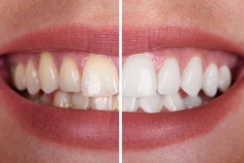 Los dientes amarillos también pueden generar problemas de autoestima.