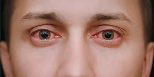 Los ojos rojos es uno de los síntomas más comunes que presentan los adictos al cannabis y otras sustancias.