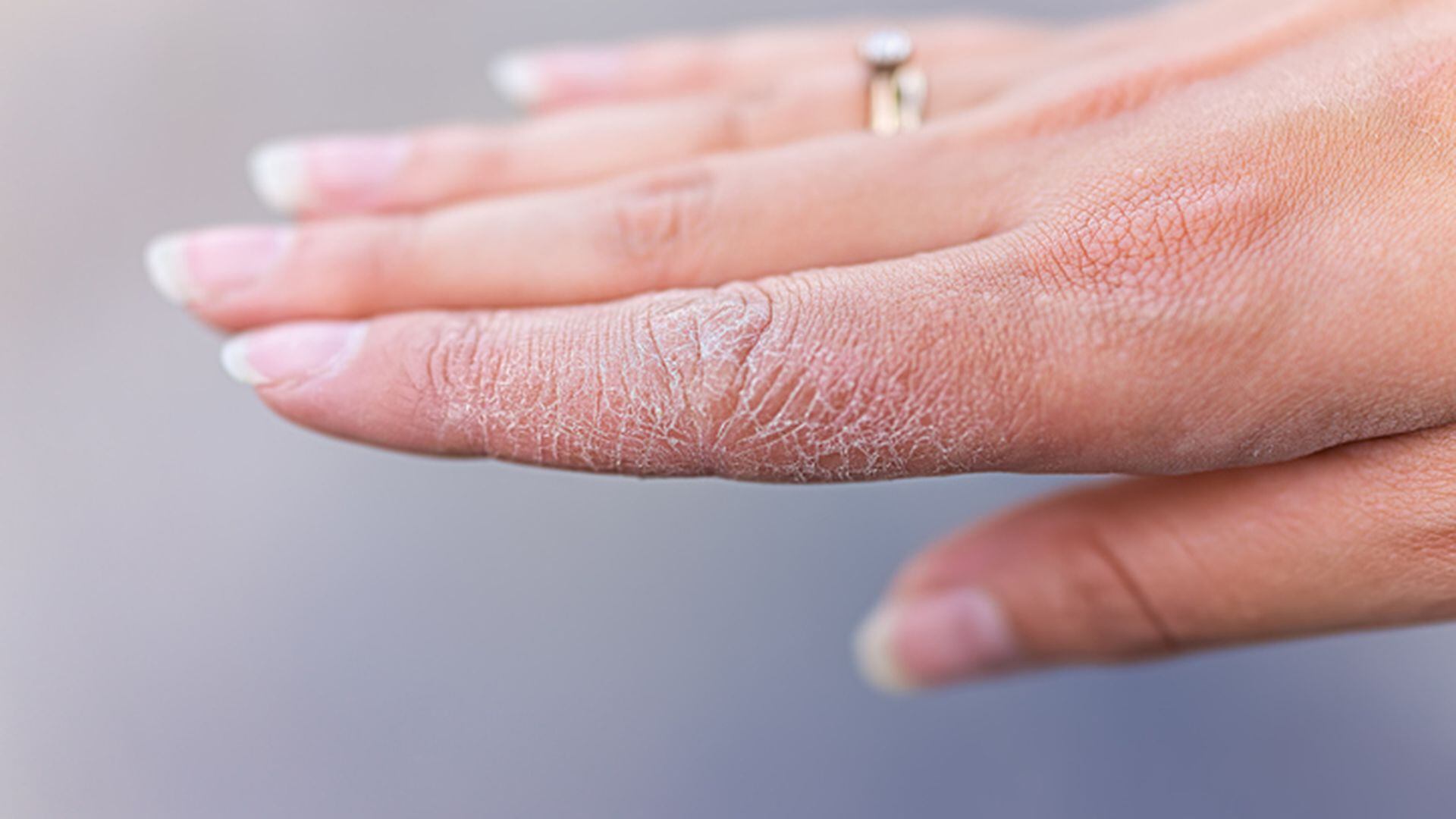 Qué vitamina falta cuando se pelan las y yemas de dedos?