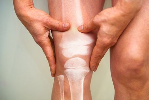 Con la artrosis, el cartílago dentro de una articulación empieza a deteriorarse, afectando también la salud de los huesos.
