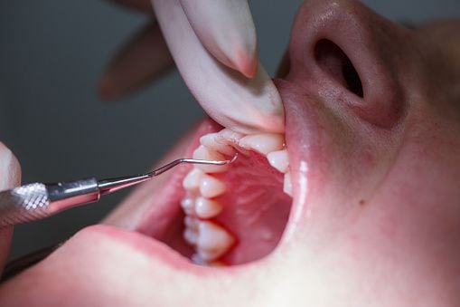 It is important that the person visits a dentist who can be consulted on appropriate treatment if this occurs.