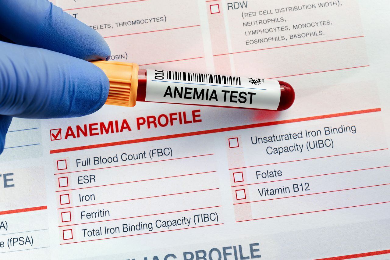 La anemia consiste en la deficiencia de glóbulos rojos.