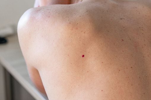 Angiomas rojas que pueden aparecer en la piel.