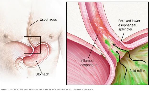 El reflujo gástrico se produce cuando el músculo esfínter que se encuentra en la parte inferior del esófago se relaja en el momento incorrecto y permite el regreso del ácido gástrico al esófago.