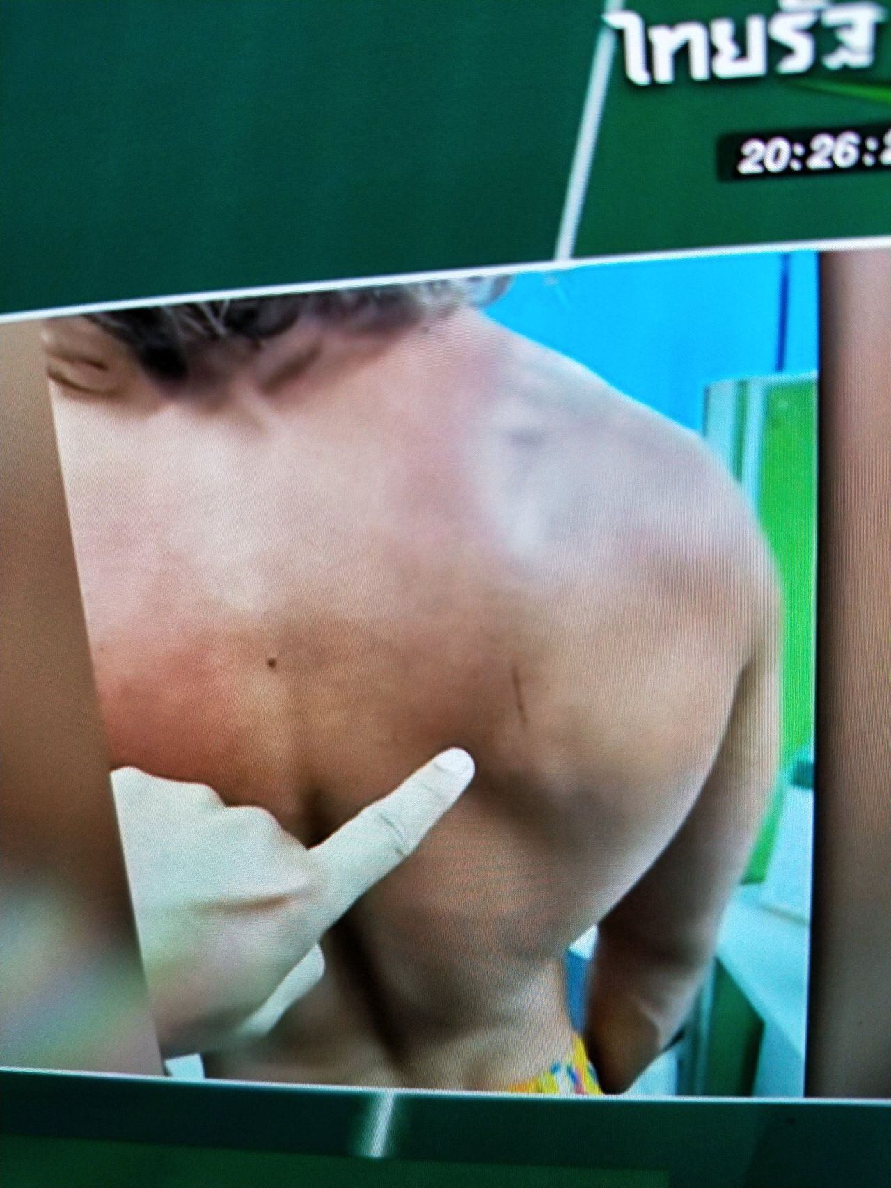 La foto muestra una herida que presentaba Sancho en su declaración ante la policía.