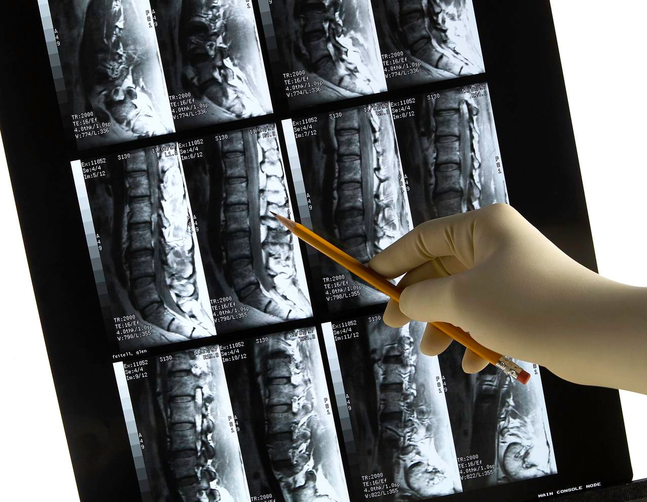 La falta de calcio puede producir osteoporosis. Foto: Getty Images