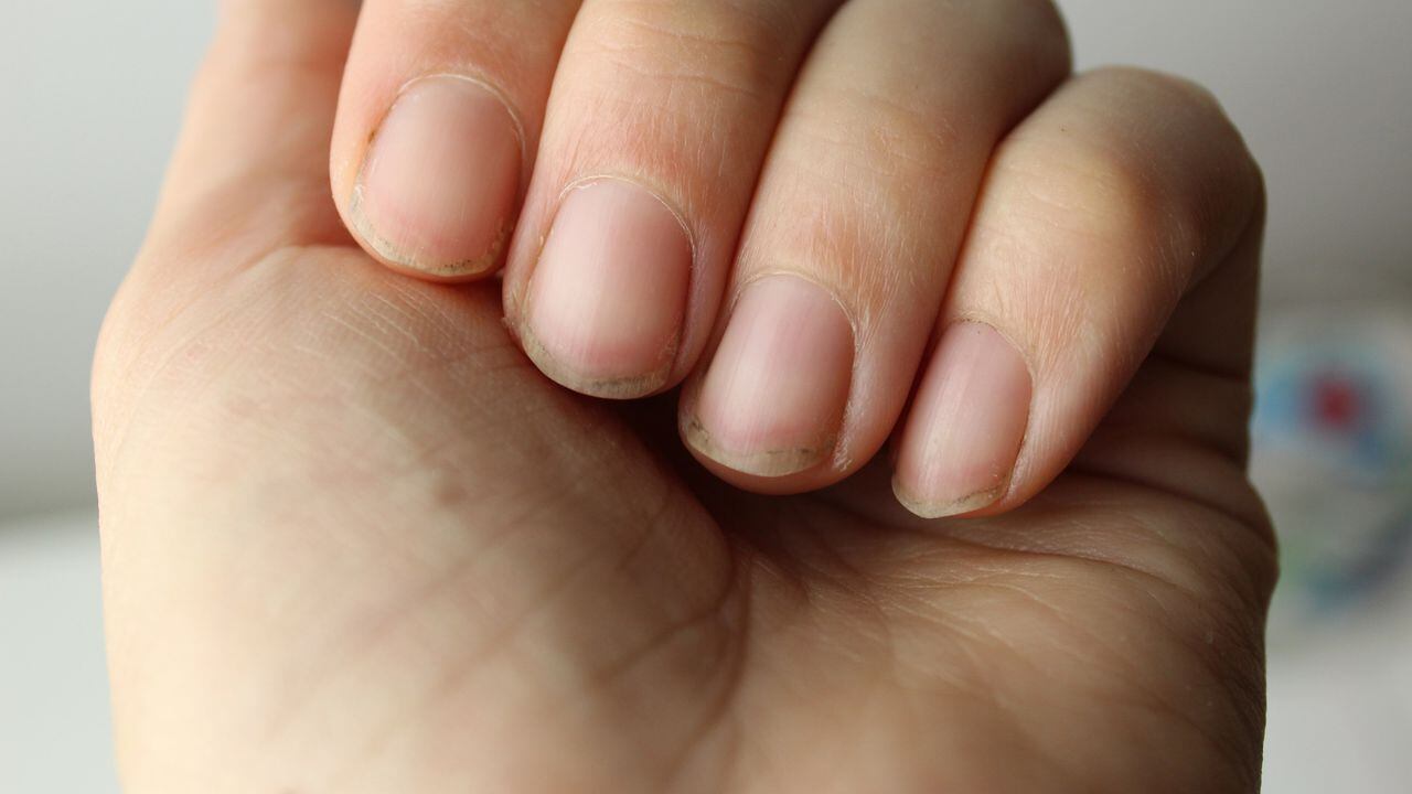 Qué enfermedad causa en el cuerpo morderse las uñas?