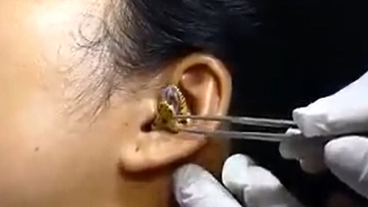 Impresionante video muestra intervención para extraer serpiente de oído de una mujer. El caso genera tanta impresión que algunas personas han señalado que podría ser falso.